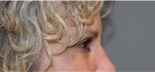 Eyelid Surgery After Photo by Ellen Mahony, MD; Westport, CT - Case 47755