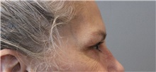 Eyelid Surgery Before Photo by Ellen Mahony, MD; Westport, CT - Case 47755