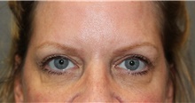 Eyelid Surgery After Photo by Ellen Mahony, MD; Westport, CT - Case 47843