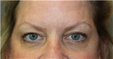 Eyelid Surgery Before Photo by Ellen Mahony, MD; Westport, CT - Case 47843