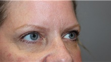 Eyelid Surgery After Photo by Ellen Mahony, MD; Westport, CT - Case 47843