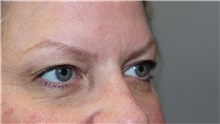 Eyelid Surgery Before Photo by Ellen Mahony, MD; Westport, CT - Case 47843