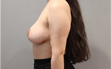 Breast Lift After Photo by Ellen Mahony, MD; Westport, CT - Case 47844