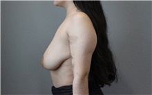 Breast Lift Before Photo by Ellen Mahony, MD; Westport, CT - Case 47844