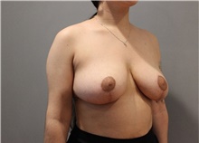 Breast Lift After Photo by Ellen Mahony, MD; Westport, CT - Case 47844