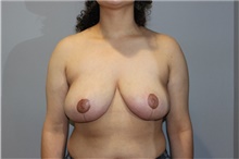 Breast Reduction After Photo by Ellen Mahony, MD; Westport, CT - Case 47919