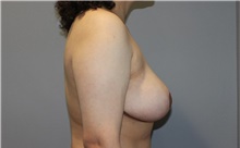 Breast Reduction After Photo by Ellen Mahony, MD; Westport, CT - Case 47919