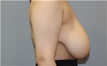 Breast Reduction Before Photo by Ellen Mahony, MD; Westport, CT - Case 47919