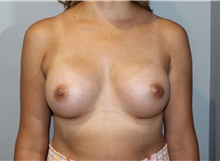 Breast Augmentation After Photo by Ellen Mahony, MD; Westport, CT - Case 47920