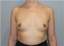 Breast Augmentation Before Photo by Ellen Mahony, MD; Westport, CT - Case 47920