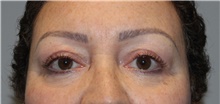 Eyelid Surgery After Photo by Ellen Mahony, MD; Westport, CT - Case 47987