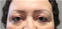 Eyelid Surgery Before Photo by Ellen Mahony, MD; Westport, CT - Case 47987