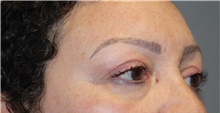 Eyelid Surgery After Photo by Ellen Mahony, MD; Westport, CT - Case 47987