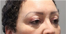 Eyelid Surgery Before Photo by Ellen Mahony, MD; Westport, CT - Case 47987