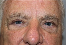 Eyelid Surgery After Photo by Ellen Mahony, MD; Westport, CT - Case 47988