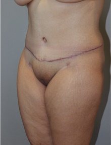 Tummy Tuck After Photo by Ellen Mahony, MD; Westport, CT - Case 48229