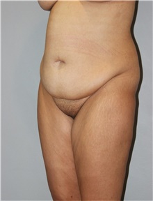 Tummy Tuck Before Photo by Ellen Mahony, MD; Westport, CT - Case 48229