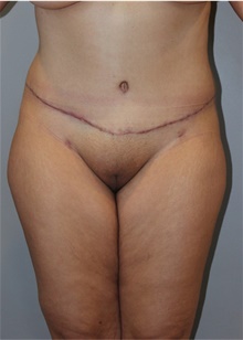 Tummy Tuck After Photo by Ellen Mahony, MD; Westport, CT - Case 48229