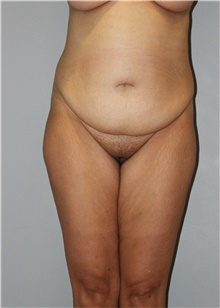 Tummy Tuck Before Photo by Ellen Mahony, MD; Westport, CT - Case 48229