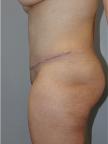 Tummy Tuck After Photo by Ellen Mahony, MD; Westport, CT - Case 48229