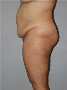 Tummy Tuck Before Photo by Ellen Mahony, MD; Westport, CT - Case 48229