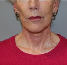 Facelift After Photo by Ellen Mahony, MD; Westport, CT - Case 48230