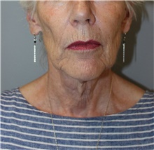 Facelift Before Photo by Ellen Mahony, MD; Westport, CT - Case 48230