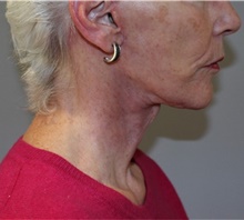 Facelift After Photo by Ellen Mahony, MD; Westport, CT - Case 48230