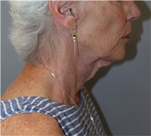 Facelift Before Photo by Ellen Mahony, MD; Westport, CT - Case 48230