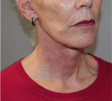 Facelift After Photo by Ellen Mahony, MD; Westport, CT - Case 48230