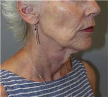 Facelift Before Photo by Ellen Mahony, MD; Westport, CT - Case 48230