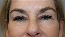 Eyelid Surgery After Photo by Ellen Mahony, MD; Westport, CT - Case 48263