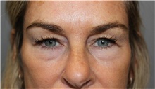 Eyelid Surgery Before Photo by Ellen Mahony, MD; Westport, CT - Case 48263