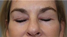 Eyelid Surgery After Photo by Ellen Mahony, MD; Westport, CT - Case 48263