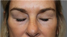 Eyelid Surgery Before Photo by Ellen Mahony, MD; Westport, CT - Case 48263