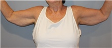 Arm Lift Before Photo by Ellen Mahony, MD; Westport, CT - Case 48300