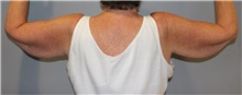 Arm Lift Before Photo by Ellen Mahony, MD; Westport, CT - Case 48300