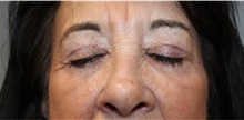 Eyelid Surgery After Photo by Ellen Mahony, MD; Westport, CT - Case 48301