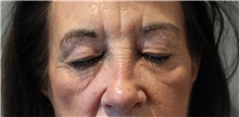 Eyelid Surgery Before Photo by Ellen Mahony, MD; Westport, CT - Case 48301