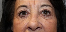 Eyelid Surgery After Photo by Ellen Mahony, MD; Westport, CT - Case 48301