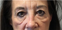 Eyelid Surgery Before Photo by Ellen Mahony, MD; Westport, CT - Case 48301