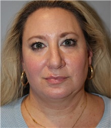 Liposuction Before Photo by Ellen Mahony, MD; Westport, CT - Case 48395
