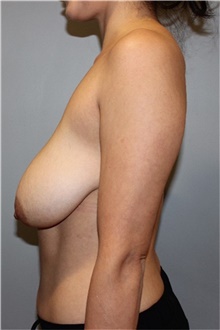 Breast Reduction Before Photo by Ellen Mahony, MD; Westport, CT - Case 48396