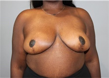 Breast Reduction After Photo by Ellen Mahony, MD; Westport, CT - Case 48504