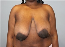 Breast Reduction Before Photo by Ellen Mahony, MD; Westport, CT - Case 48504