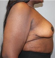 Breast Reduction After Photo by Ellen Mahony, MD; Westport, CT - Case 48504