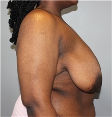 Breast Reduction Before Photo by Ellen Mahony, MD; Westport, CT - Case 48504