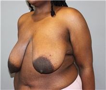 Breast Reduction Before Photo by Ellen Mahony, MD; Westport, CT - Case 48504