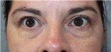 Eyelid Surgery After Photo by Ellen Mahony, MD; Westport, CT - Case 48506