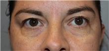 Eyelid Surgery Before Photo by Ellen Mahony, MD; Westport, CT - Case 48506